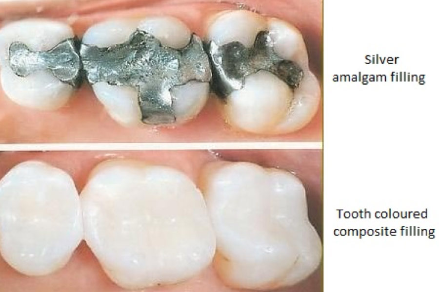 Photo showing a comparison between amalgam fillings and composite.
