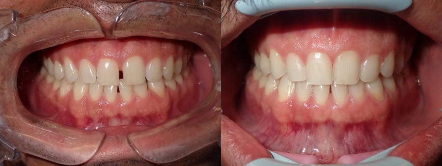 invisalign-before-and-after