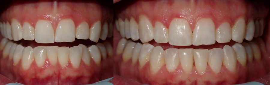 Invisalign Before & After